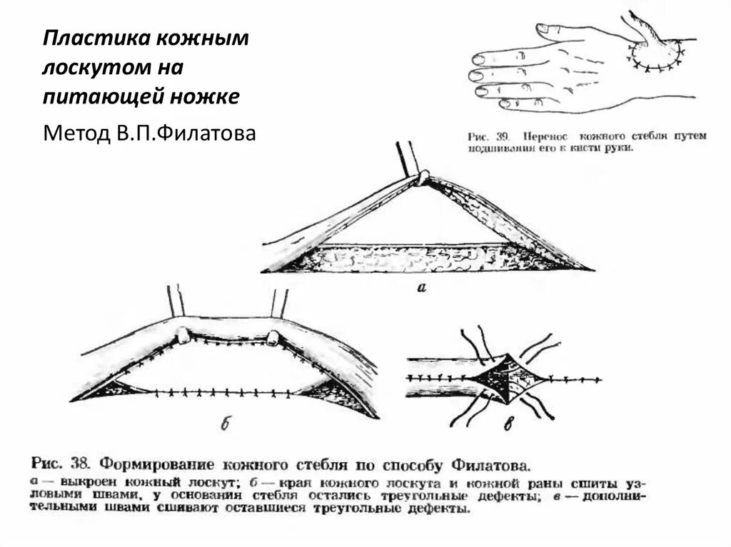 Грыжесечение sublay пластика. Пластика паховой грыжи по жирару-спасокукоцкому. Грыжесечение sublay пластика. Пластика по другому. Пластика грыжи жирару спасокукоцкому.