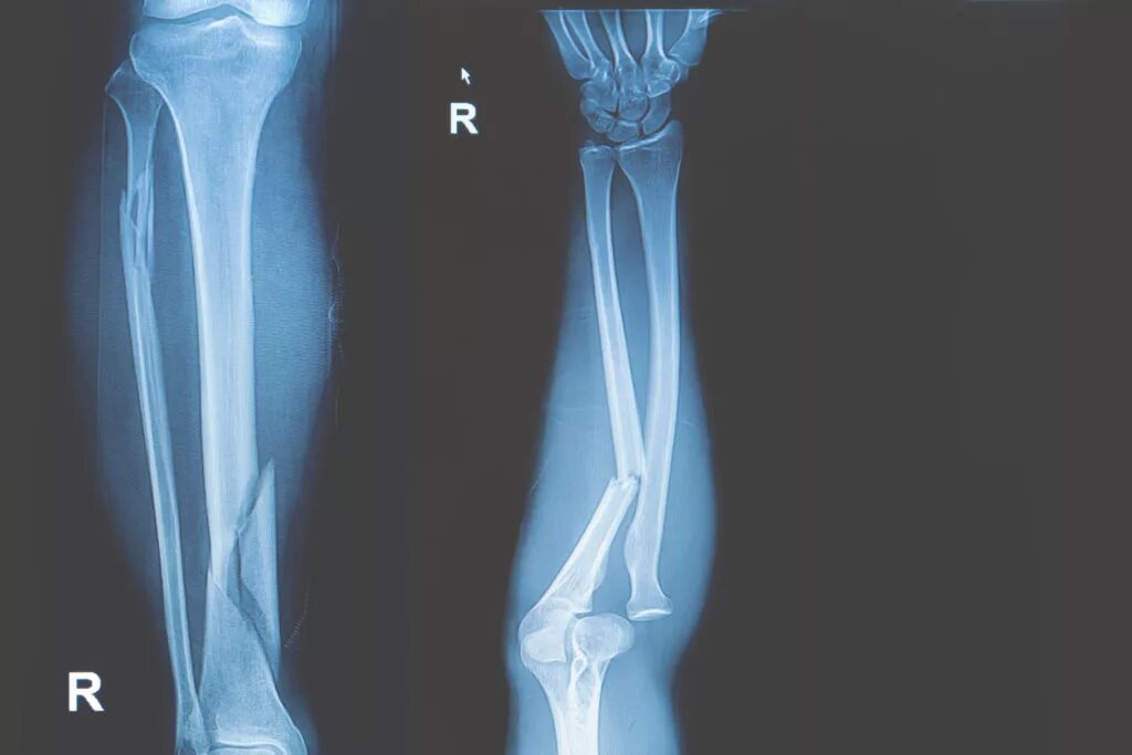 Открытый перелом кости руки. Открытый перелом ноги берцовая кость. Перелом малоберцовой кости рентген. Перелом ноги со смещением рентген.