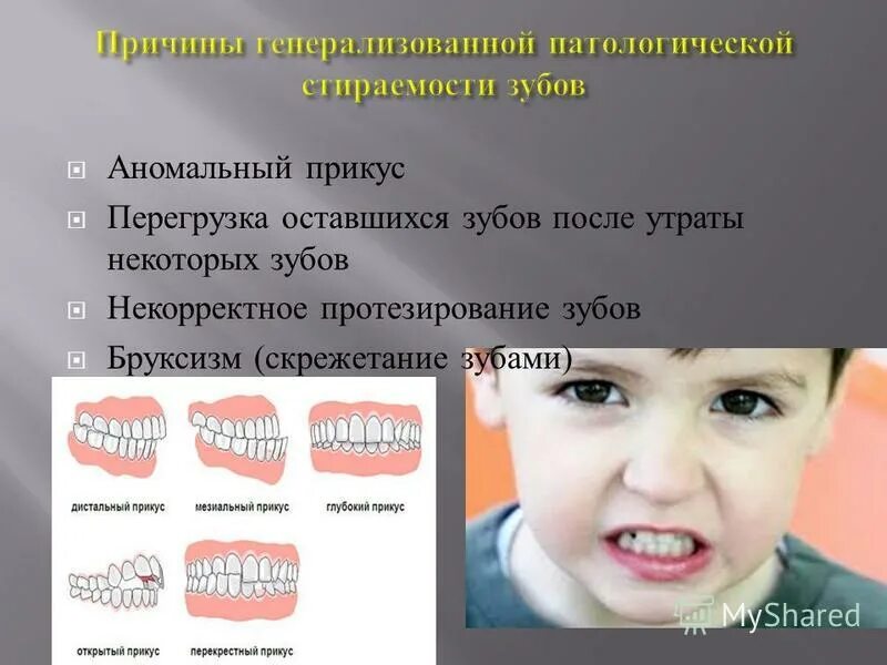 Бруксизм у детей причины. Бруксизм у детей причины