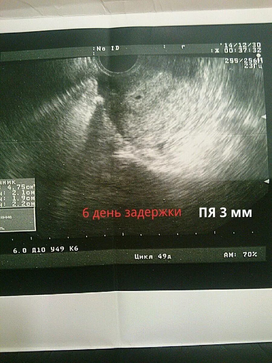 Узи беременности на ранних сроках 1-2 недели. Узи беременности с задержкой в 5 дней. Узи 1 неделя беременности. Беременность на узи до задержки. Узи 5 дней задержки беременности.