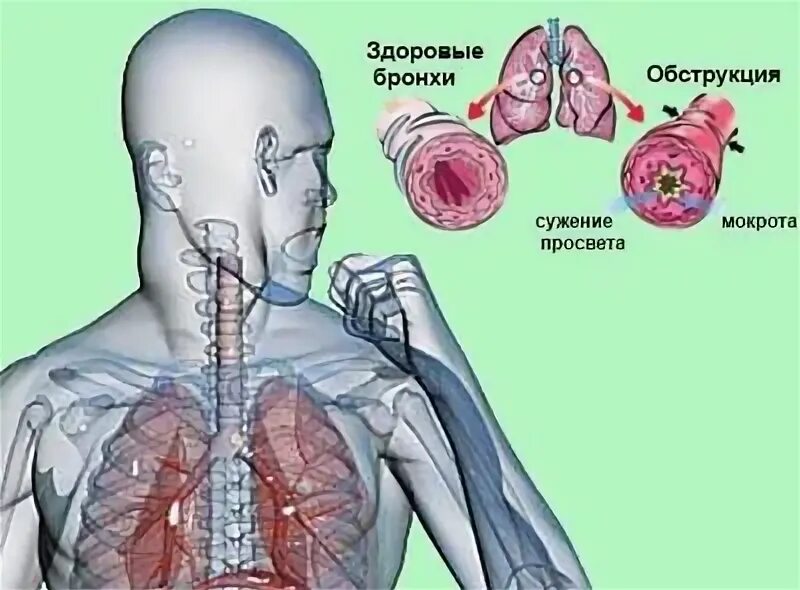 Диффузный бронхит. Диффузный бронхит