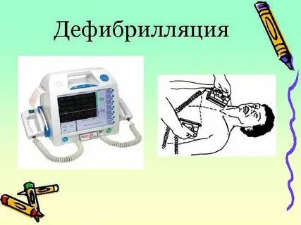 Дефибрилляция сердца