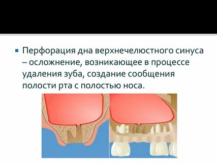 Перфорация гайморовой пазухи
