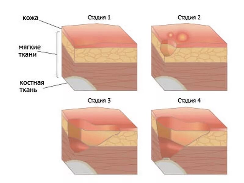 Начальная фаза трофической язвы. Трофические язвы стадии. Салфетки язвы