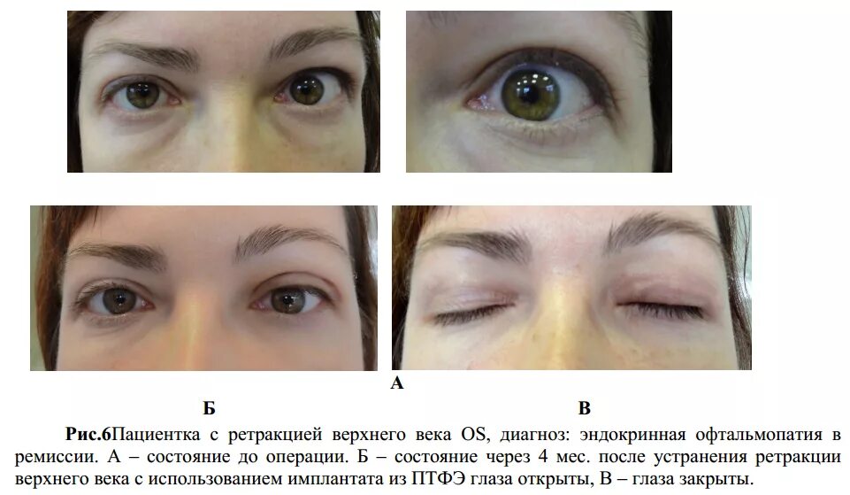 Эндокринная офтальмопатия птоз. Веко верхнее птоз 1 степени.