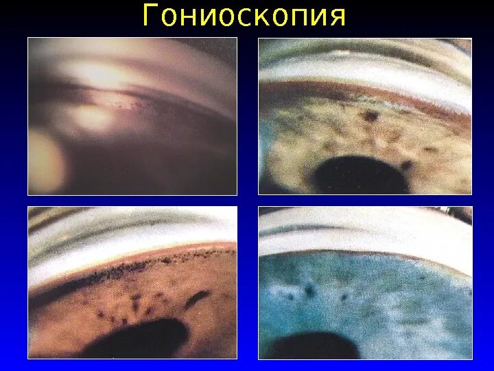 Гониоскопия - исследование угла передней камеры. Гониоскопия глаза. Гониоскопия глаукома. Гониоскопия глаза. Линза гольдмана гониоскопия.