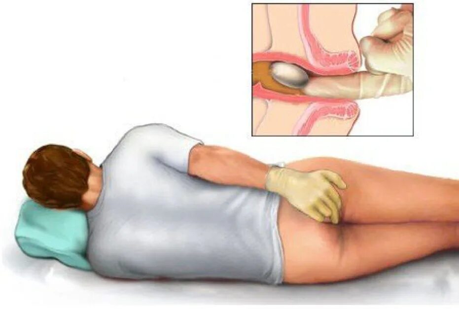 Ректальный человек. Как вводить свечи ректально. Что такое ректальное Введение свечей. Введение свечи в прямую кишку. Как вставить свечу ректально.