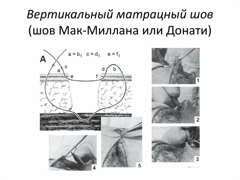 Вертикальный матрацный шов донати. Шов донати в модификации альговера. Шов хирургический внутрикожный. Вертикальный матрацный шов по донати. Шов по донати техника.