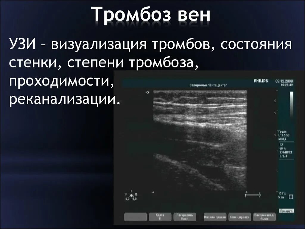 УЗИ вен верхних конечностей протокол УЗИ. Тромбоз глубоких вен УЗИ заключение. Реканализация тромба на УЗИ. Тромбофлебит поверхностных вен УЗИ заключение. Тромбоз без флотации