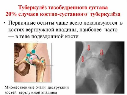 Фазы костно суставного туберкулеза