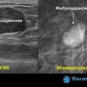 Листовидная фиброаденома