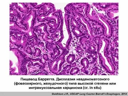 Фовеолярная гиперплазия