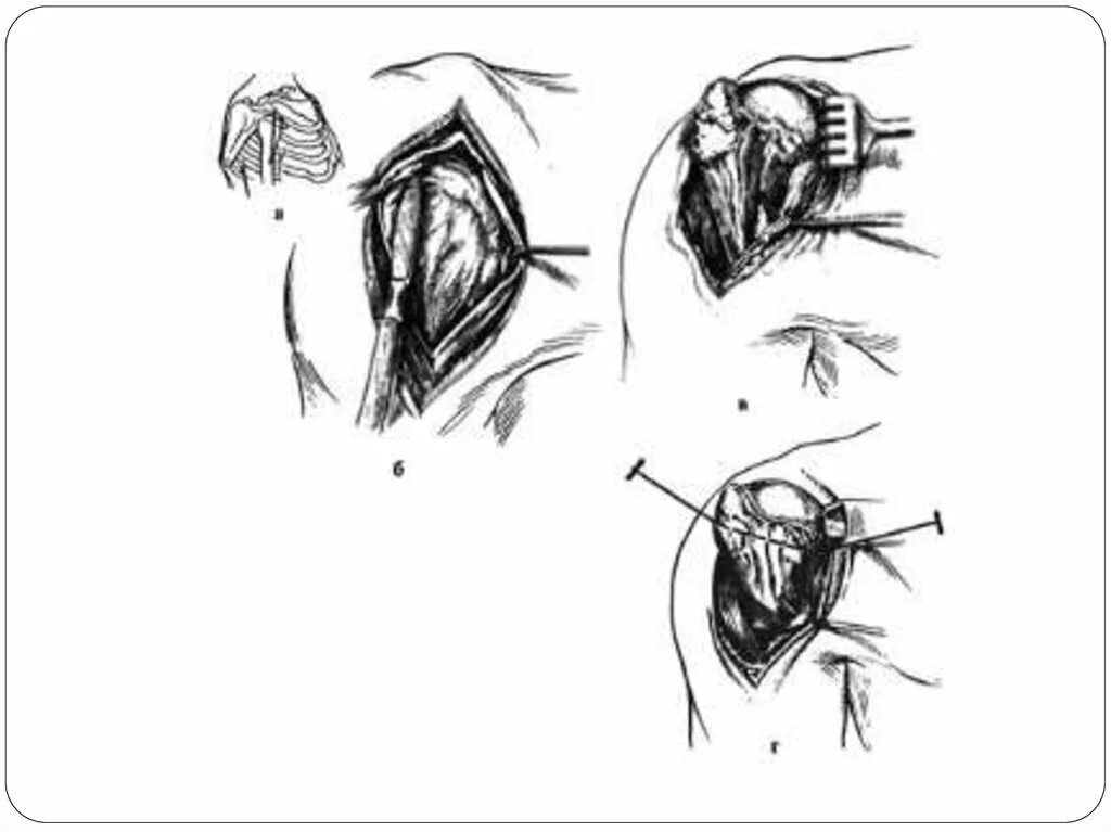 Артротомия плечевого сустава. Артротомия плечевого сустава по Лангенбеку. Задняя артротомия плечевого сустава. Парапателлярная артротомия коленного сустава.
