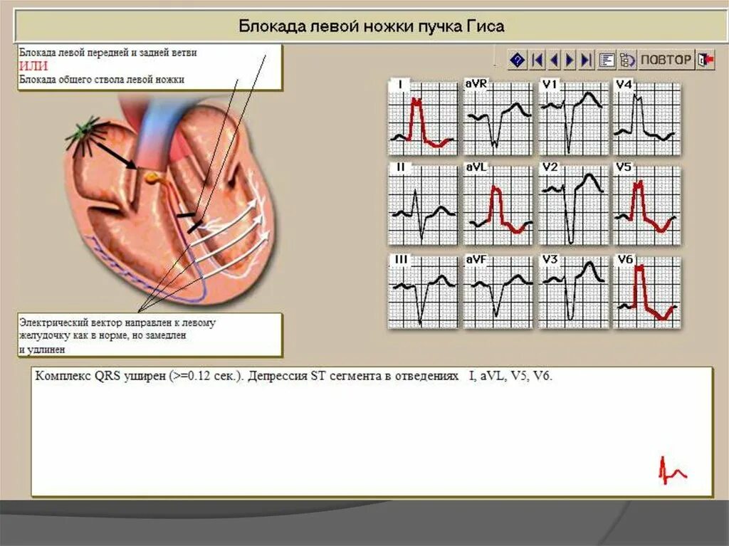 Неполная блокада ножек и ветвей пучка гиса