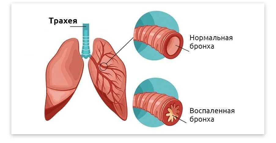 Бронхит латынь