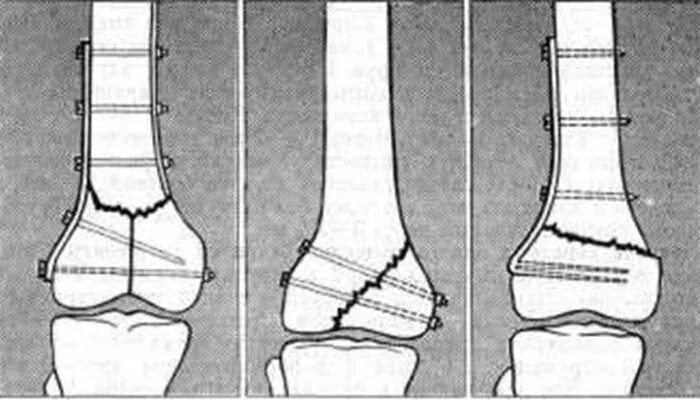 Остеосинтез мыщелка бедренной кости. Накостный остеосинтез бедренной кости. Остеосинтез бедренной большеберцовой кости. Перелом мыщелка большеберцовой кости.