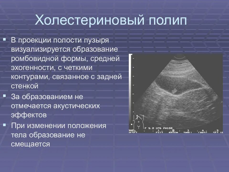 Лечение полипов в желчном пузыре народными средствами. Полип желчного пузыря на УЗИ. Холестериновые полипы в желчном пузыре на УЗИ. Холестериновый полип на УЗИ. Ультрасонография желчного пузыря полип.