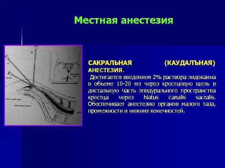 Обезболивающая блокада. Сакральная анестезия. Сакральная эпидуральная анестезия. Местная анестезия. Сакральная (каудальная) анестезия.