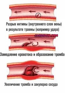 Разрыв сосуда причины