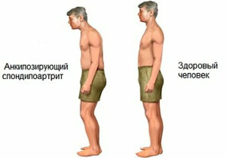 Болезнь бехтерева как выглядит. Болезнь бехтерева-анкилозирующий. анкилозирующий спондилоартрит болезнь бехтерева. поза просителя бехтерева. анкилозирующий спондилит болезнь бехтерева.