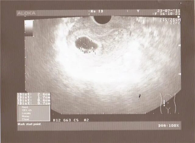 6 недель 3 мм. Узи плодное яйцо 6 недель. Узи беременность 2 плодных яйца. Узи на 6 неделе беременности. Узи плодного яйца на 2-3 недели.