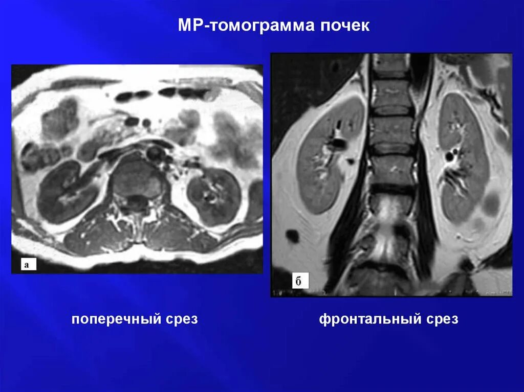 Фронтальный срез почки. Фронтальные срезы EPB. Кт вирсунголитиаза.