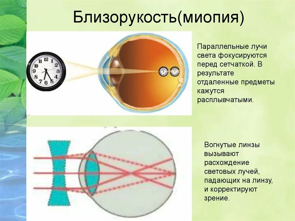 У близоруких людей изображение фокусируется перед сетчаткой. Строение глаза миопия. Близорукость схема хода лучей. Близорукость перед сетчаткой. Близорукость строение глаза.