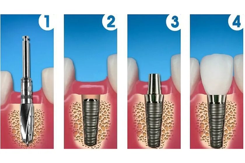 Зубы импланты поэтапно