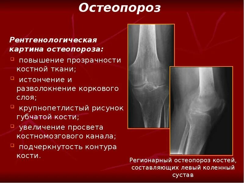 Остеопороз 1-2 степени тазобедренного сустава. Остеопороз коленного сустава кт. Остеопороз коленного сустава рентген. Остеопороз кости рентген признаки. Болят лучевые кости почему