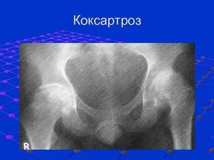 Код по мкб коксартроз тазобедренных суставов