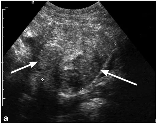 Признаки опухолей матки на УЗИ. Гипоэхогенный эндометрий. Карцинома эндометрия матки УЗИ. Рак матки на узи виден