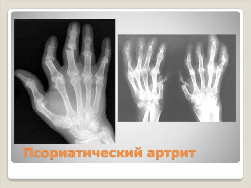 псориатический артрит симптомы и признаки