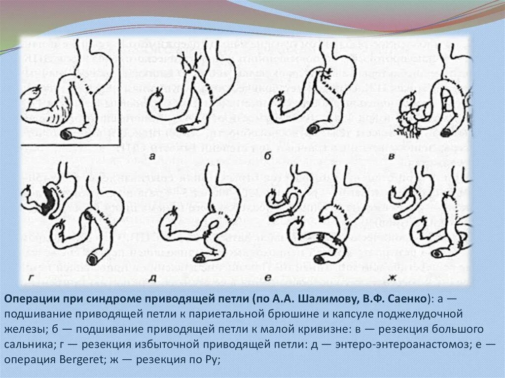 Бильрот 2 приводящая петля. Синдром приводящей петли после резекции. Клинические формы синдрома приводящей петли. Понятие порочного круга синдрома приводящей петли. Расширение петель кишечника