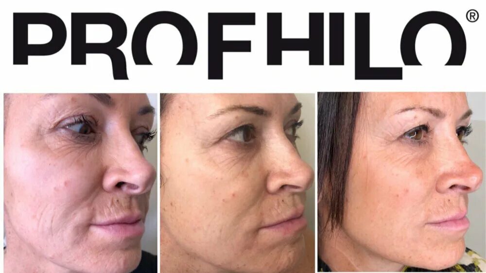 Botox Wrinkle Removal Dublin Factory Sale beztabaka.by