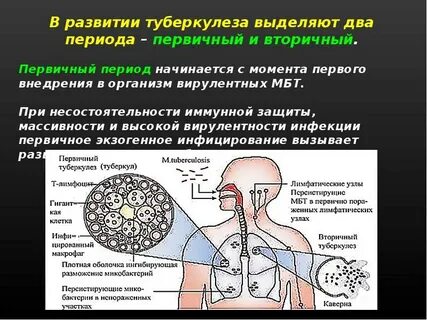 Туберкулез возникновение