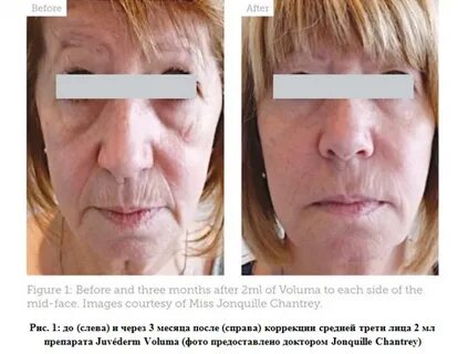 Восстановление средние