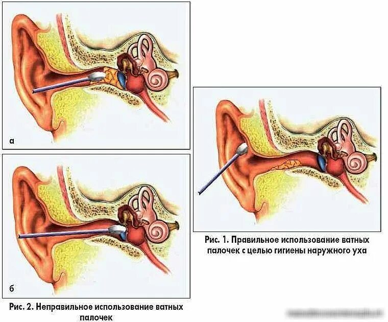 Ухо заложило после чистки палочкой. Как чистить уши ватной палочкой. Как правильно почистить уши от серы. Почему нельзя чистить уши ватными палочками. Как достать пробку из уха ватной палочкой.