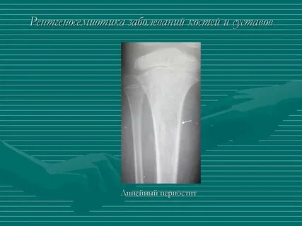 Периостит кости