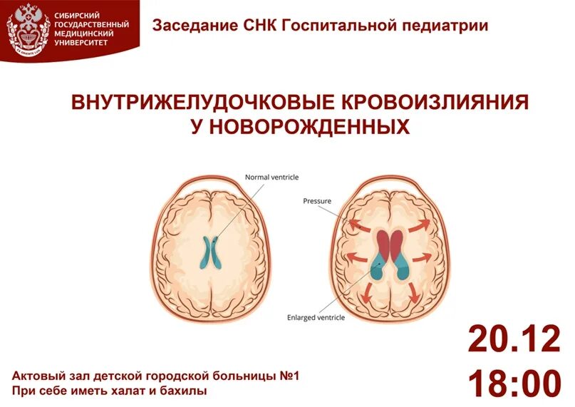 Кровоизлияние в мозг у недоношенных новорожденных 1 степени. ВЖК 2-3 степени у новорожденных. Внутримозговые кровоизлияния у новорожденных. Внутрижелудочковое кровоизлияние у новорожденных степени.