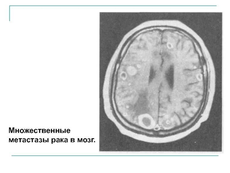 Метастазы головного мозга кт. Многочисленные опухоли головного мозга. многочисленные новообразования в головном мозге. множественные метастазы в головной мозг.