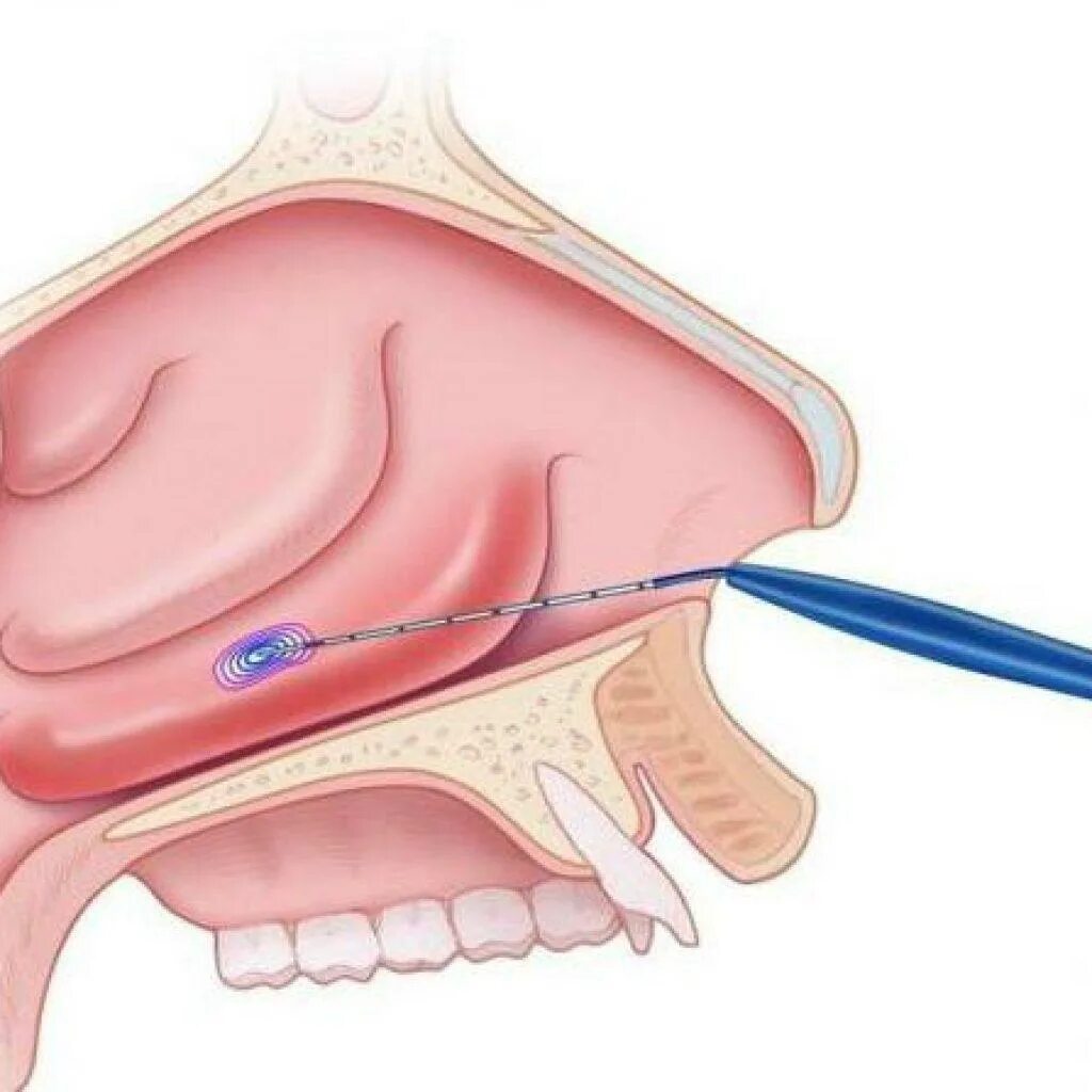Подслизистая вазотомия. Радиоволновая вазотомия. Вазотомия носовых раковин. Отек слизистой от капель