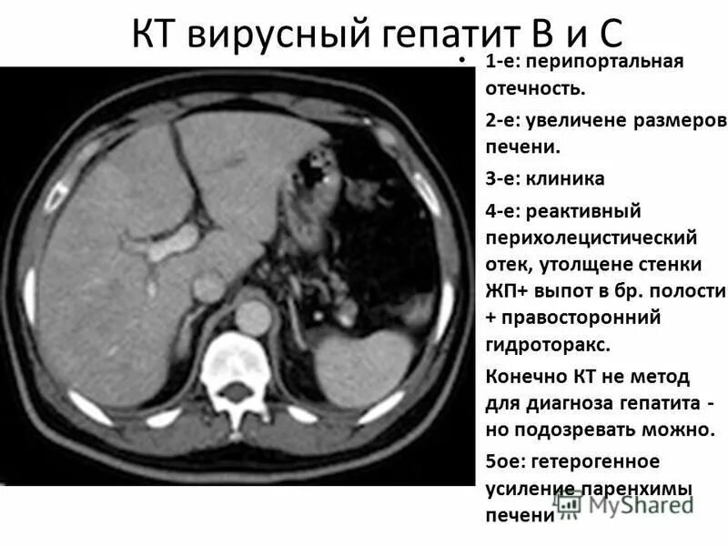 Гепатит желчный пузырь