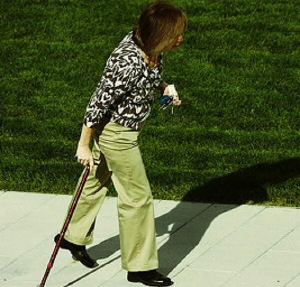 мужчина на костылях. костыли для ходьбы с поломанной ногой. мужчина с костылями на улице. ходьба на костылях после эндопротезирования коленного сустава. человек на костылях.