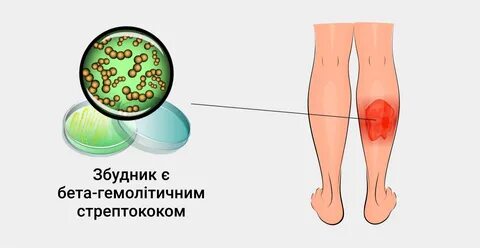 Прогноз рожи