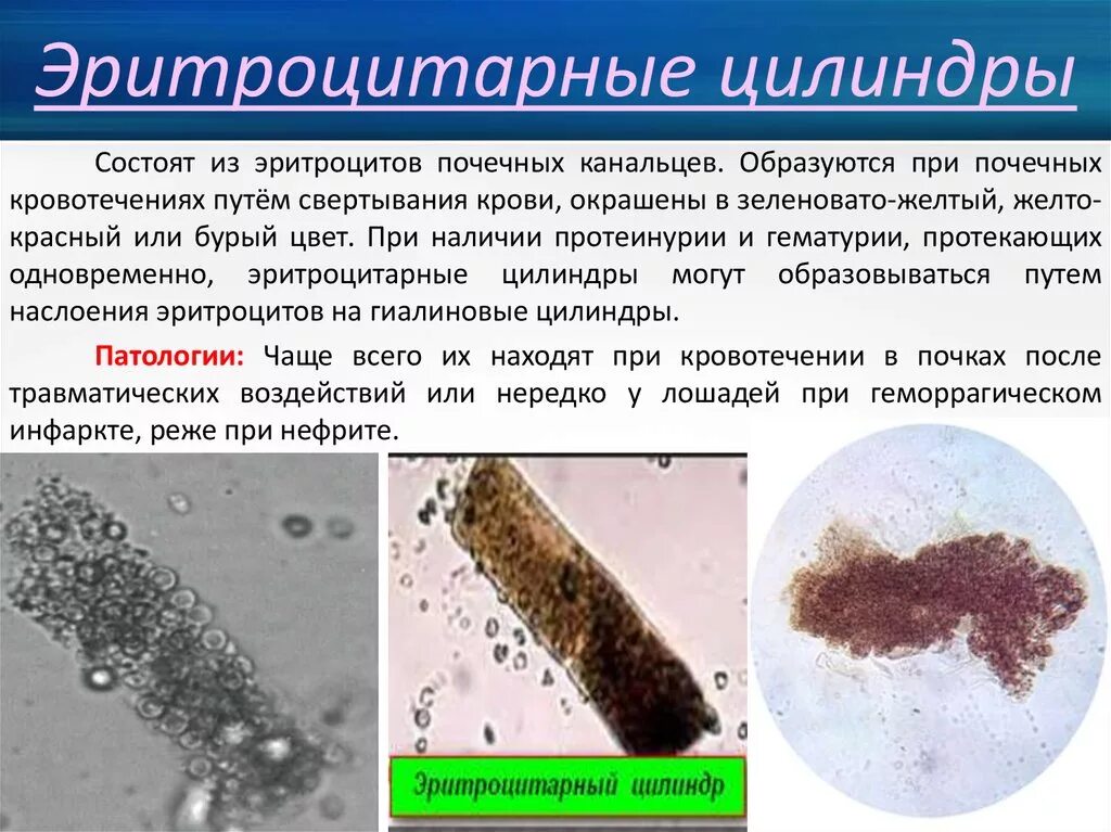 Моча цилиндры гиалиновые повышенные. Зернистые и восковидные цилиндры в моче. Гиалиновые и зернистые цилиндры. Лейкоцитарные цилиндры в моче. Эритроцитарные цилиндры в моче.