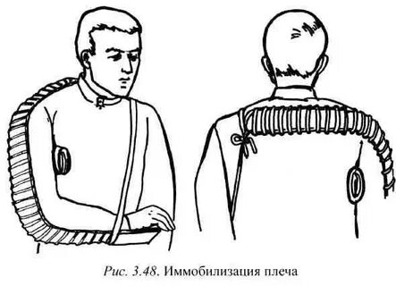 Иммобилизация плеча