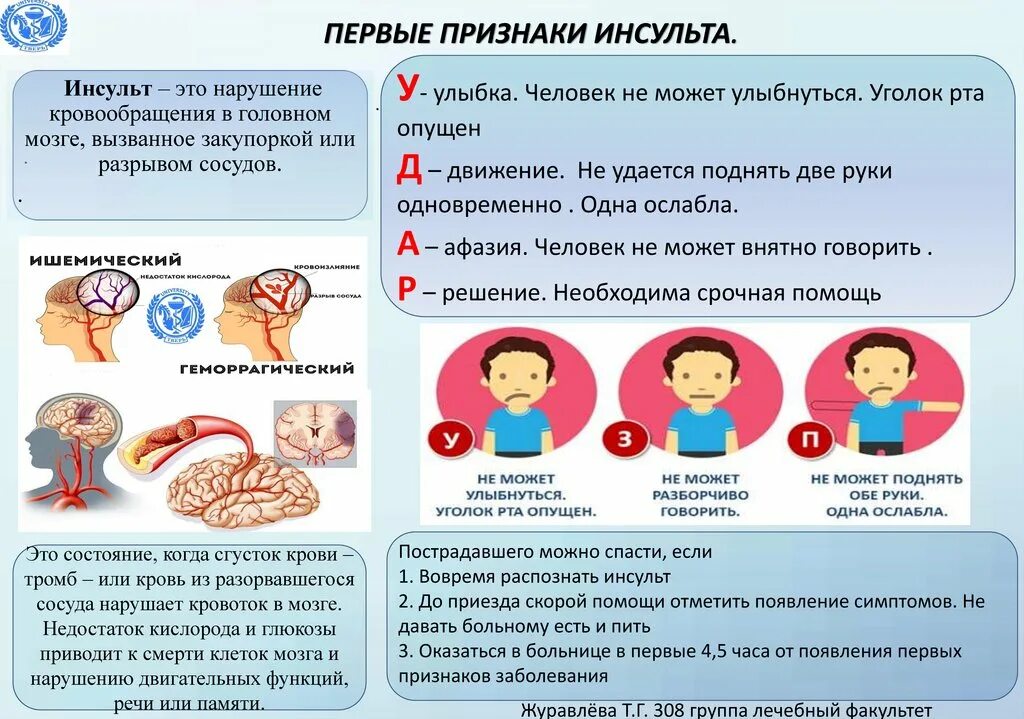 Инсульт симптомы как лечить. Инсульт симптомы как лечить