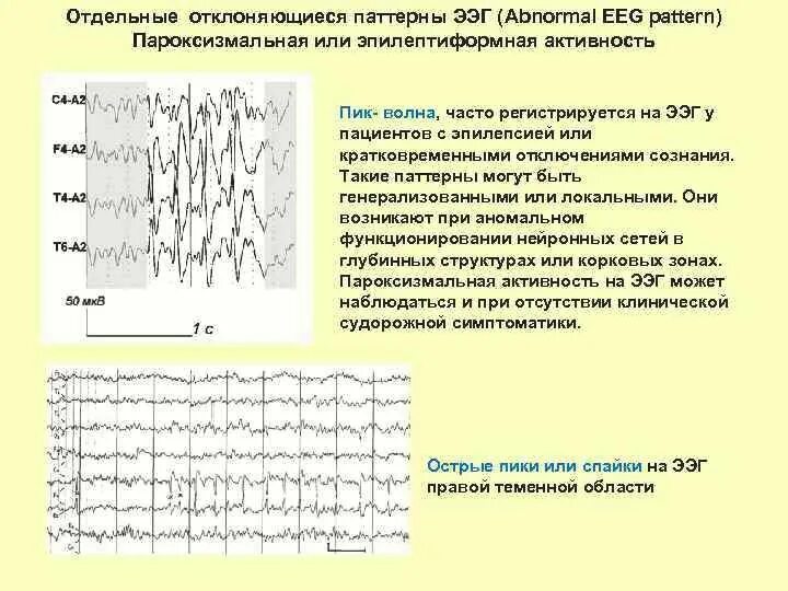 Дезорганизованный тип ээг. Эпилептиформные паттерны на ЭЭГ. Пароксизмальная активность на ЭЭГ У ребенка. Эпи паттерны на ЭЭГ. ЭЭГ эпилепсия пик-волна.