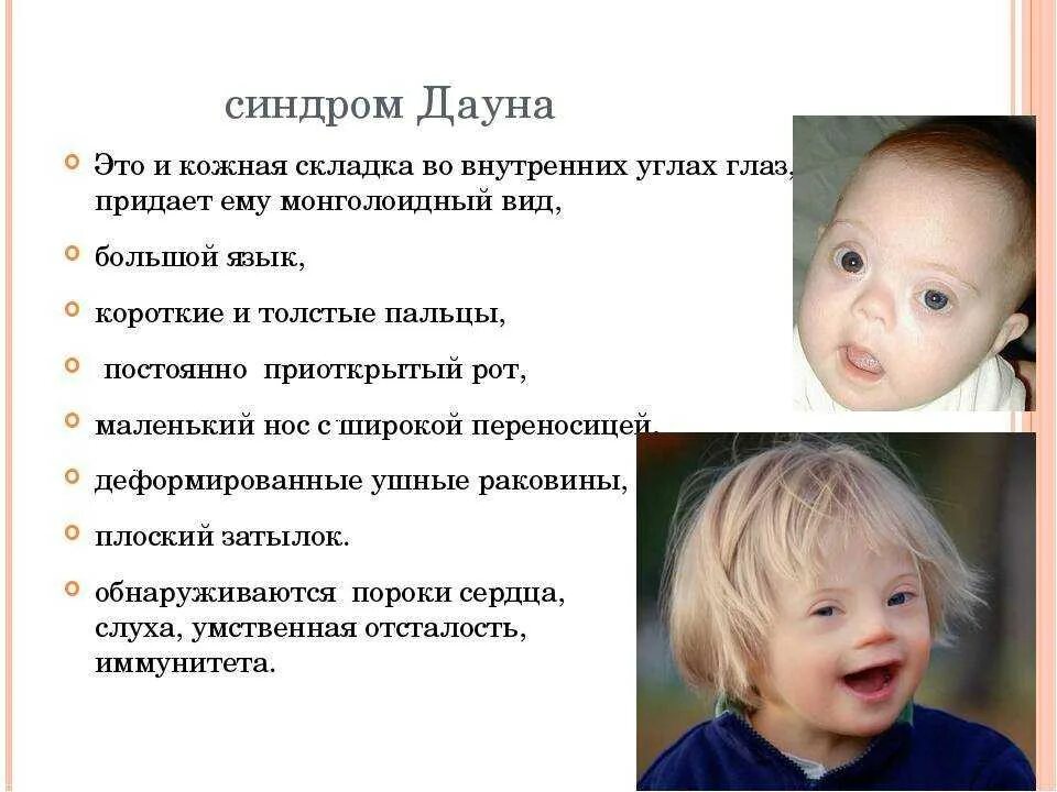 Помощь людям с синдромом дауна. Характерные признаки проявления болезни синдрома дауна. синдром дауна признаки у детей.