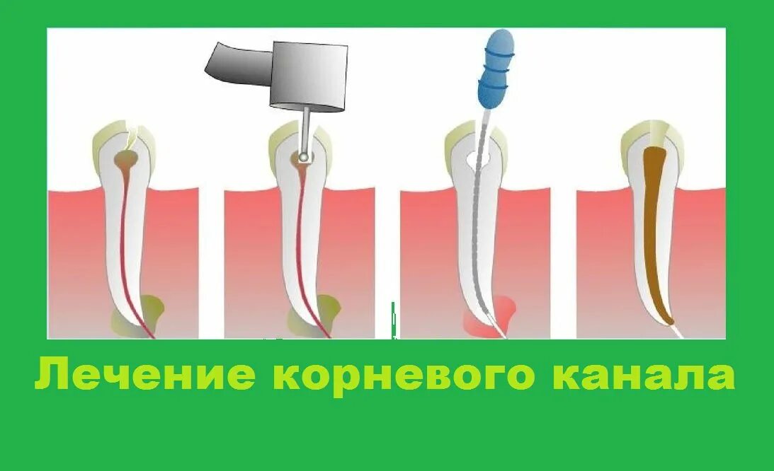 Временное пломбирование корневых каналов. Пульпит корневого канала. Пломбирование корневых каналов. Термофил пломбировка каналов. Корневой канал при воспалении пульпы пломбируют.